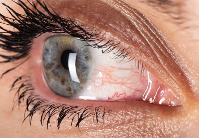 Closeup of a womans dry bloodshot eye