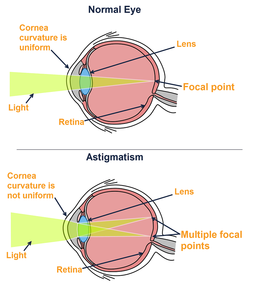Diagram of normal eye vs eye with astigmatism